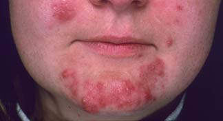 Someone's chin covered in red acne blemishes