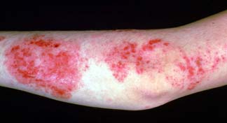 Red dry sores of eczema on someone's elbow