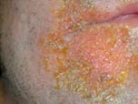 Crusty, yellow sores near the mouth caused by the impetigo bacteria