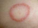 A close up of a red ring on someone's skin caused by the ring worm fungi