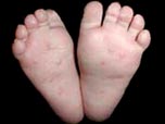 A close up of a pair of feet with red marks caused by the scabies parasite