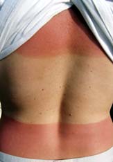 Severe sunburn on someone's back